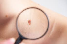 Prevención del Cáncer de Piel: lo que la ciencia más reciente enseña